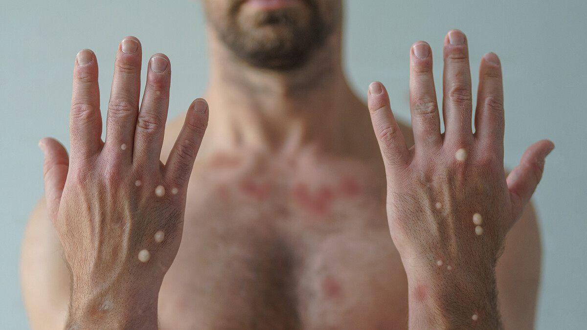 Photo of an individual with monkeypox.